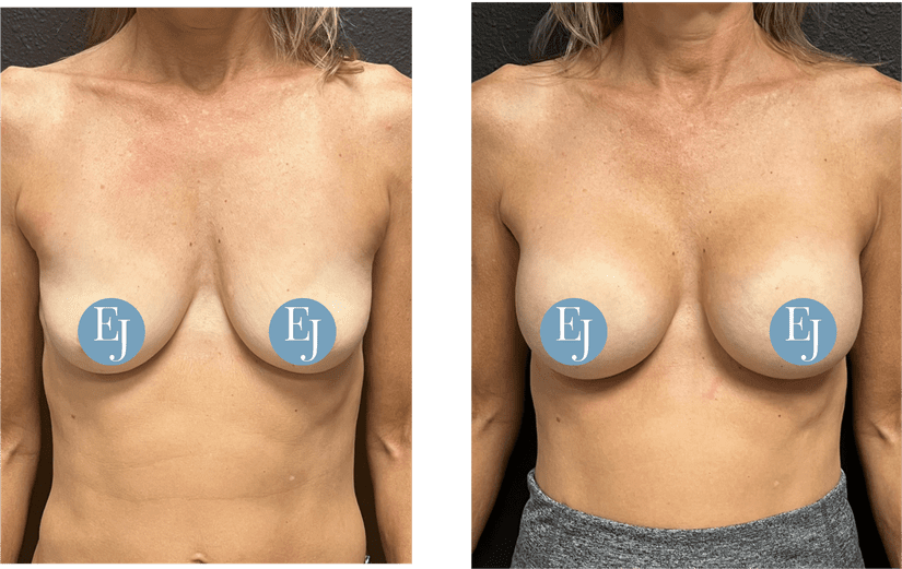 Breast-Augmentation-before-after