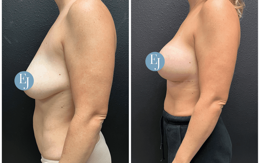 Breast-Augmentation-before-after