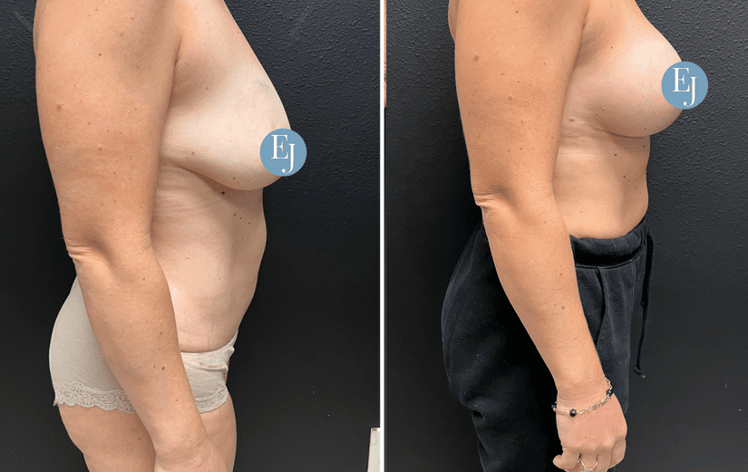 Breast-Augmentation-before-after