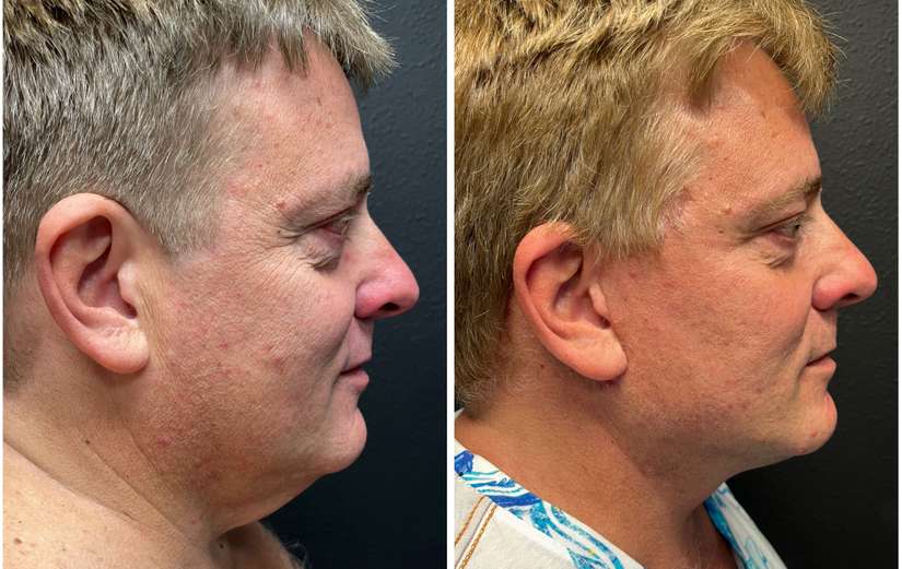 Facelift-before-after