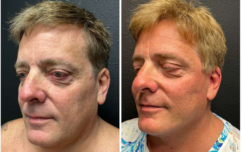 Facelift-before-after