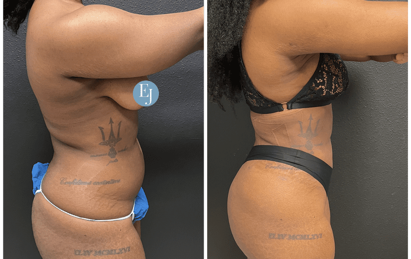 Liposuction-before-after
