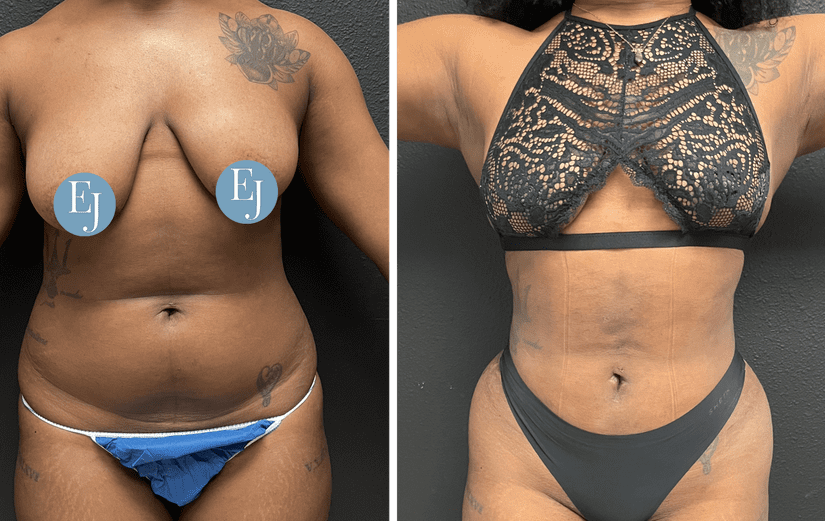 Liposuction-before-after