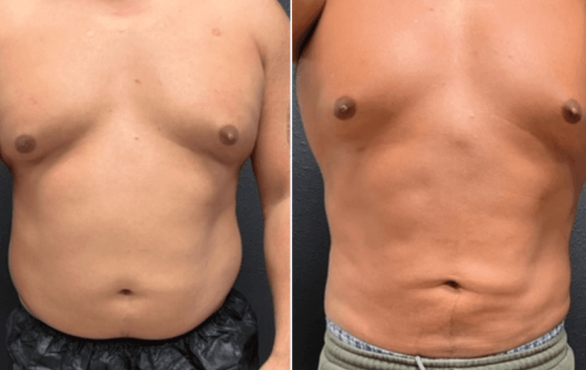 Liposuction-before-after