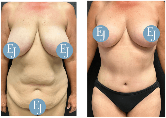 Mommy-Makeover-before-after