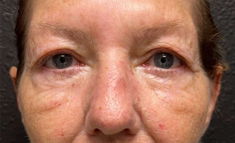blepharoplasty-lp-before-after