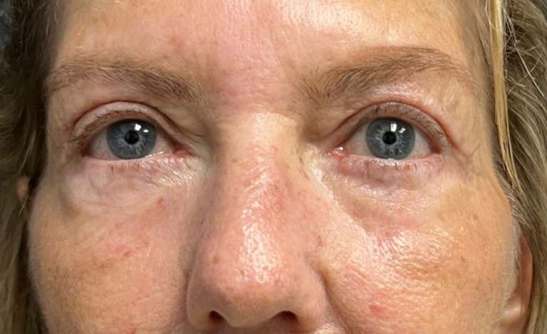blepharoplasty-lp-before-after