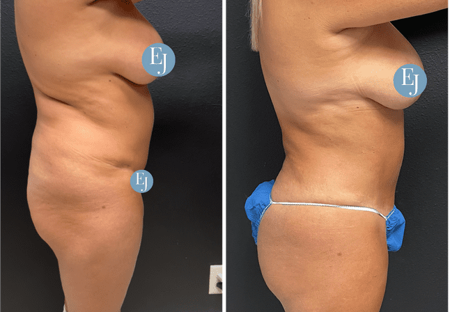 Brazilian buttocks lift before after