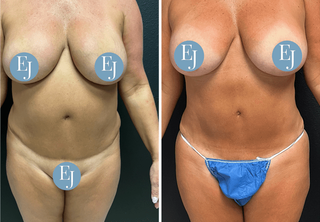 Brazilian buttocks lift before after