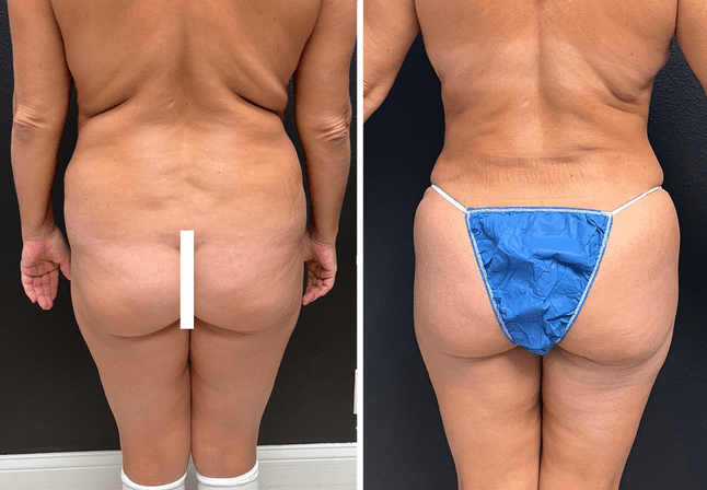 Brazilian buttocks lift before after