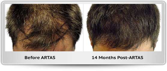hair-restoration-transplant