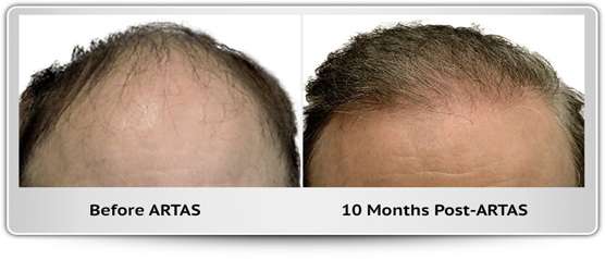 hair-restoration-transplant