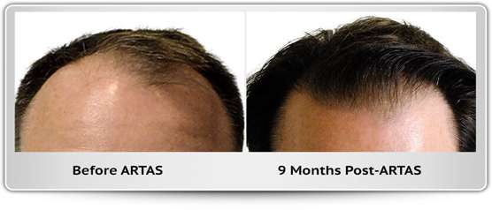 hair-restoration-transplant