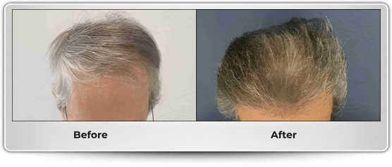 hair-restoration-transplant