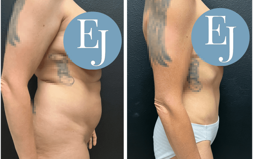 tummy-tuck-before-after