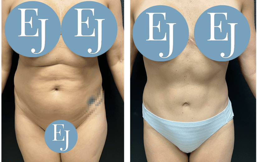 tummy-tuck-before-after
